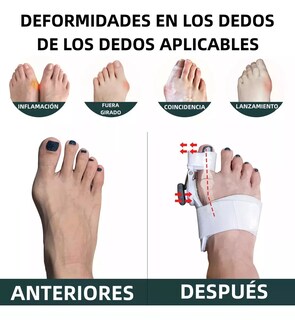 Foto 4 | Foto 4 | Corrector De Juanetes Sistema Quick-fit: Alivio Y Ajuste De Angulos (talla Universal)