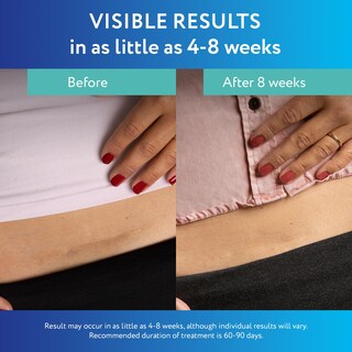 Foto 4 | Foto 4 | Láminas De Silicona Para Tratamiento De Cicatrices Scaraway Advanced X6 - Venta Internacional.