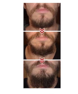 Foto 5 | Foto 5 | Derma Roller Lab.g 0.5 Mm Para Barba Y Facial Cabello Negro