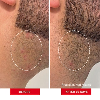Foto 4 | Foto 4 | Almohadillas Para Cabello Encarnado First Aid Beauty Bha + Aha 60 Almohadillas - Venta Internacional.