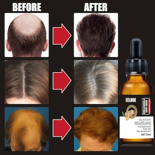 Foto 3 | Foto 3 | Aceite Esencial Para El Crecimiento Del Cabello Huoguo Plant Anticaída  30 Ml - Venta Internacional.