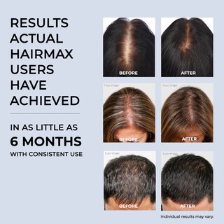 Foto 5 | Foto 5 | Dispositivo Para El Crecimiento Del Cabello Hairmax Laser Band 41 Aprobado Por La Fda - Venta Internacional.