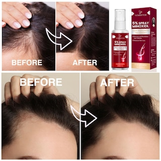 Foto 4 | Foto 4 | Tratamiento Para El Crecimiento Del Cabello Yzmoffer Con 5% De Minoxidil Para Mujeres 60 Ml - Venta Internacional.