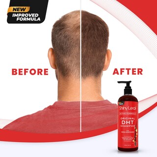Foto 7 | Foto 7 | Champú Shiny Leaf Dht Que Bloquea El Crecimiento Del Cabello, Paquete De 2 - Venta Internacional.