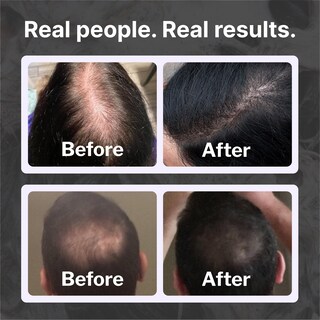 Foto 4 | Foto 4 | Shampoo Shapiro Md Hair Growth Experts Para Pérdida De Cabello Durante 4 Meses - Venta Internacional.