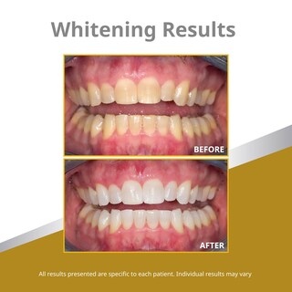 Foto 4 | Foto 4 | Recambio De Jeringas En Gel Blanqueador Opalescence 45% (4 X 1 2 Ml) - Venta Internacional.