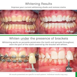 Foto 3 | Foto 3 | Bandejas Blanqueadoras Opalescence Go 15% Con Pasta De Dientes 30 Ml - Venta Internacional.