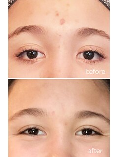 Foto 4 | Foto 4 | Spot Gel Perricone Md Para Aliviar El Acné, Máxima Potencia, 15 Ml - Venta Internacional.