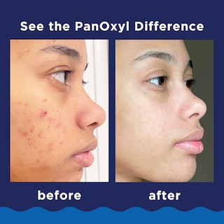 Foto 4 | Foto 4 | Limpiador Facial Panoxyl Acne Foaming Con Peróxido De Benzoilo 10% 90 Ml - Venta Internacional.