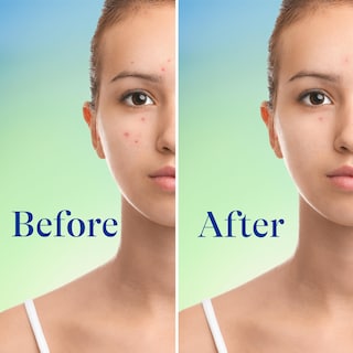 Foto 6 | Foto 6 | Jabón Facial Differin con Peróxido de Benzoilo al 10% 148 ml - Venta Internacional