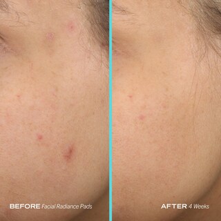 Foto 7 | Foto 7 | Almohadillas Exfoliantes First Aid Beauty Facial Radiance, 28 Almohadillas - Venta Internacional.