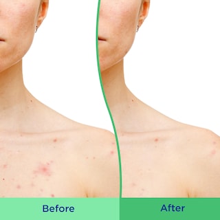 Foto 5 | Foto 5 | Exfoliante Corporal Differin Con Ácido Salicílico Para Eliminar El Acné 240 Ml - Venta Internacional.
