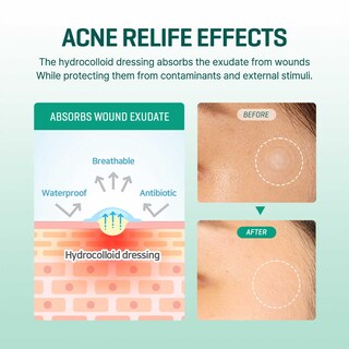 Foto 5 | Foto 5 | Spot Patch Some By Mi 30 Days Miracle Clear, Paquete De 5 X 90 - Venta Internacional.