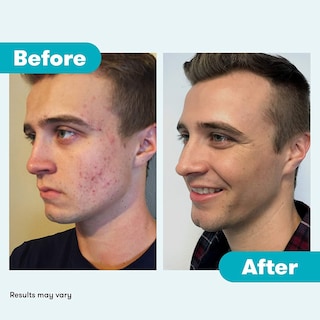 Foto 8 | Foto 8 | Tratamiento Para El Acné Proactiv Repair Con Peróxido De Benzoilo Durante 90 Días - Venta Internacional.