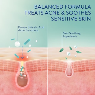 Foto 3 | Foto 3 | Sérum Cetaphil Gentle Clear de Triple Acción para el Acné 30 ml con Ácido Salicílico - Venta Internacional