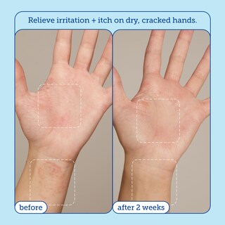 Foto 4 | Foto 4 | Crema Para Aliviar Las Manos Skinfix Reduce El Enrojecimiento 90 Ml Piel Seca - Venta Internacional.