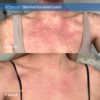 Foto 2 | Foto 2 | Bálsamo Para Aliviar El Eccema Skinfix Eczema+ Dermatitis 50 Ml - Venta Internacional.