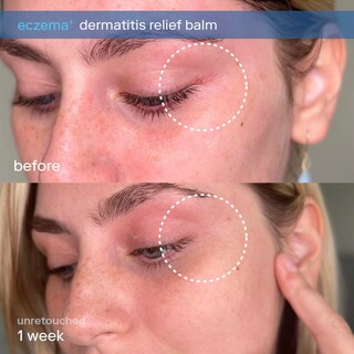 Foto 3 | Foto 3 | Bálsamo Para Aliviar El Eccema Skinfix Eczema+ Dermatitis 50 Ml - Venta Internacional.