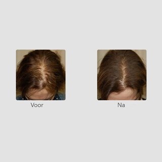 Foto 4 | Foto 4 | Acondicionador Foligain Triple Action Para Mujeres Con Cabello Fino - Venta Internacional.