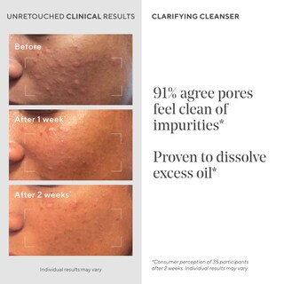 Foto 4 | Foto 4 | Limpiador Murad Clarifying Acne Control Con Ácido Salicílico 150 Ml - Venta Internacional.