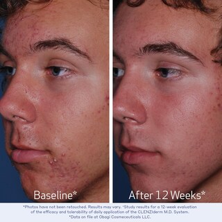 Foto 4 | Foto 4 | Tónico Obagi Clenziderm M.d. Pore Therapy Con 2% De Ácido Salicílico - Venta Internacional.