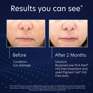 Foto 4 | Foto 4 | Corrector De Manchas Oscuras Pca Skin Sin Hidroquinona 30 Ml - Venta Internacional.