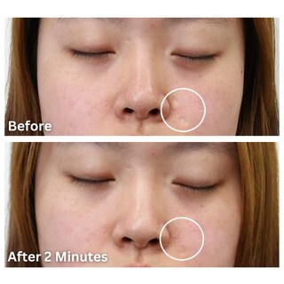 Foto 5 | Foto 5 | Aplicador De Relleno De Cicatrices Dermaflage - Venta Internacional.