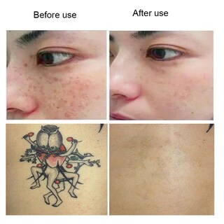 Foto 3 | Foto 3 | Eliminación De Tatuajes Con Láser Azul Con Láser De Picossegundos - Venta Internacional.