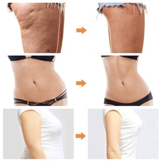 Foto 1 | Foto 1 | Masajeador Adelgazante Con Máquina De Liposucción Rondon - Venta Internacional.