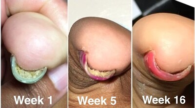 Foto 4 | Foto 4 | Aceite De Uñas Probelle Natural Fungal Colour Restoration 15 Ml - Venta Internacional.