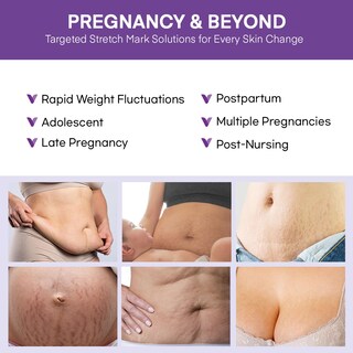 Foto 4 | Foto 4 | Crema De Estrías Vigority Para Mujeres Embarazadas 120 Ml - Venta Internacional.