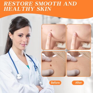Foto 4 | Foto 4 | Pomada Congelante En Gel De Acción Rápida Bighero Remover Wart Remover Paquete De 2 - Venta Internacional.