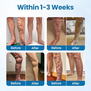 Foto 2 | Foto 2 | Spray Herbal Bicotand Veinguard Professional Para Varices 30 Ml 2 Unidades - Venta Internacional.
