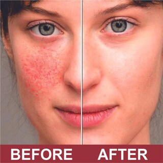 Foto 5 | Foto 5 | Crema Contra La Picazón Quatriderm Nf Extra Strength Con Hidrocortisona Al 1% - Venta Internacional.