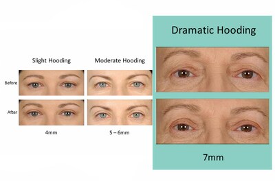 Foto 4 | Foto 4 | Tiras Elevadoras De Párpados Contours Rx Lips By Design 7 Mm 80 Unidades - Venta Internacional.