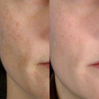 Foto 6 | Foto 6 | Inicio Kit De Microdermoabrasión Pmd Microderm Classic Para Rostro - Venta Internacional.