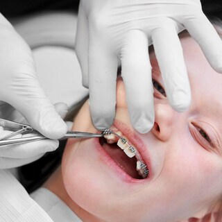 Foto 7 | Foto 7 | Kit De Remoción Y Cambio De Color De Aparatos De Ortodoncia Dental | Dexsur - Venta Internacional.