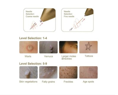Foto 4 | Foto 4 | Quita Verrugas Lunares Manchas Pecas Tatuajes