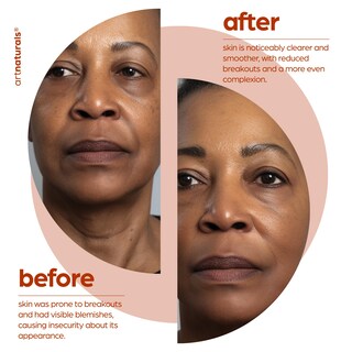 Foto 5 | Foto 5 | Serum Artnaturals Aceite De Control De Ácido Salicílico Al 2% Bha 30 Ml - Venta Internacional.