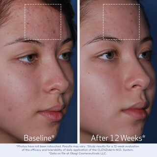 Foto 5 | Foto 5 | Limpiador De Piel Obagi Clenziderm M.d. Set De Ácido Salicílico Al 2% - Venta Internacional.
