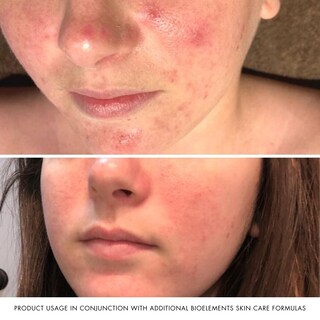Foto 5 | Foto 5 | Exfoliante Facial Bioelements Measured Micrograins 120 Ml Para Toda La Piel - Venta Internacional.