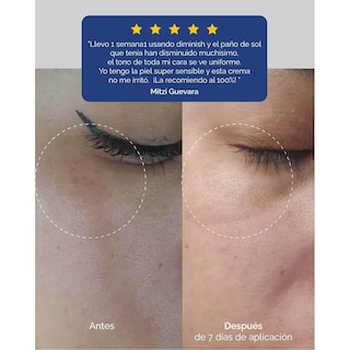 Foto 5 | Foto 5 | Crema Despigmentante Kareco Diminish Con Ácido Azelaico Vitamina C Hialurónico Facial