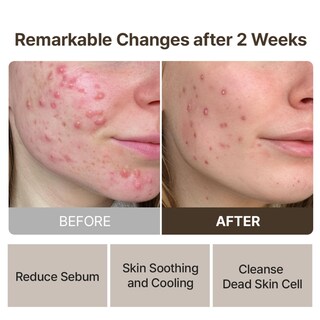 Foto 5 | Foto 5 | Mascarilla Facial Mommy Care Potato Wash Off Pack 100g – Tratamiento Suave Para Poros Dilatados Y Piel Clara