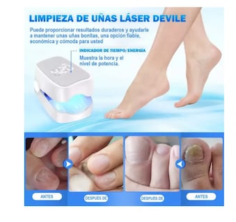 Foto 4 | Foto 4 | Tratamiento Láser De Hongos En Las Uñas Y Onicomicosis